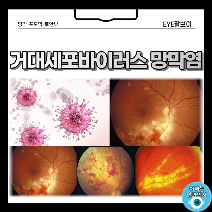 거대세포바이러스 눈감염(망막염) - 임상양상과 합병증