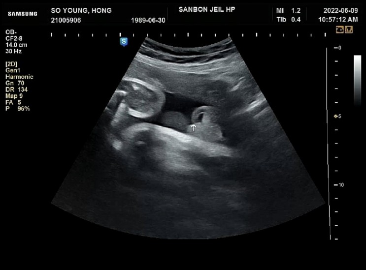 임신 37주 4일, 산본제일병원 제왕절개 관련, 유착방지, 페인버스터 부작용, PCR검사 보험적용까지