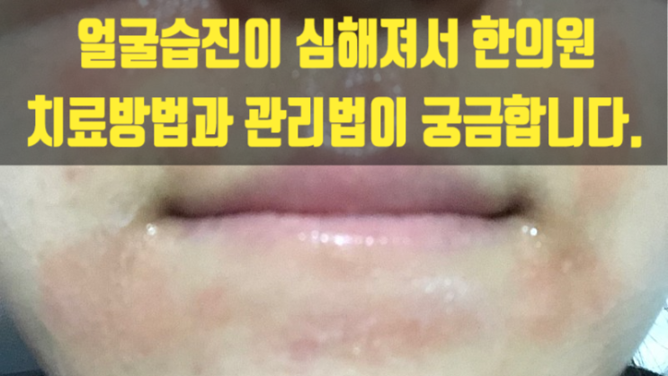  얼굴습진이 심해져서 한의원 치료방법과 관리법이 궁금합니다.