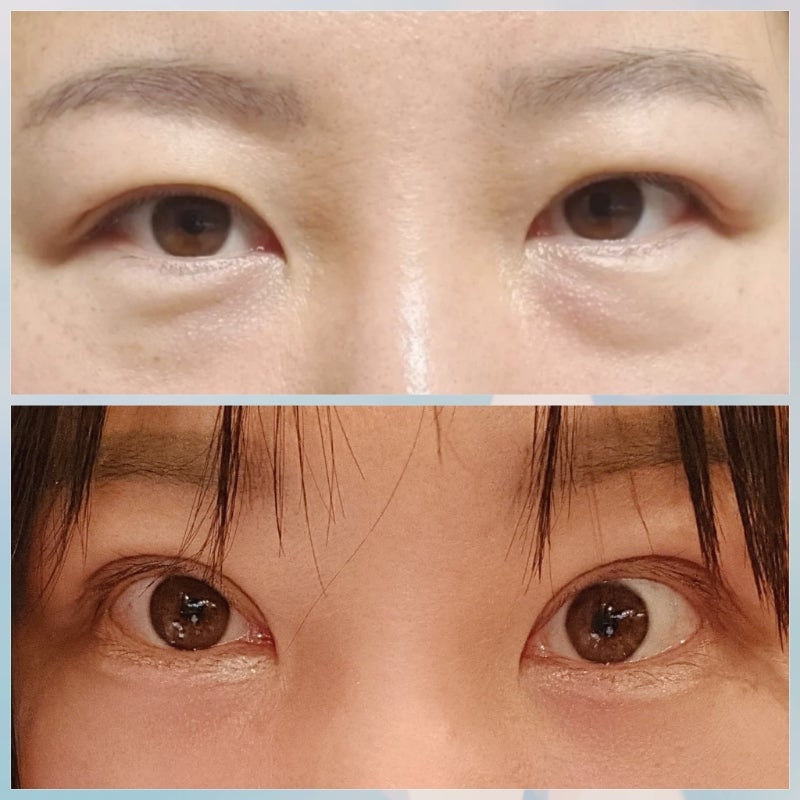 후레쉬 정형외과 60대 상안검하안검수술 2개월째 후기 내돈내산