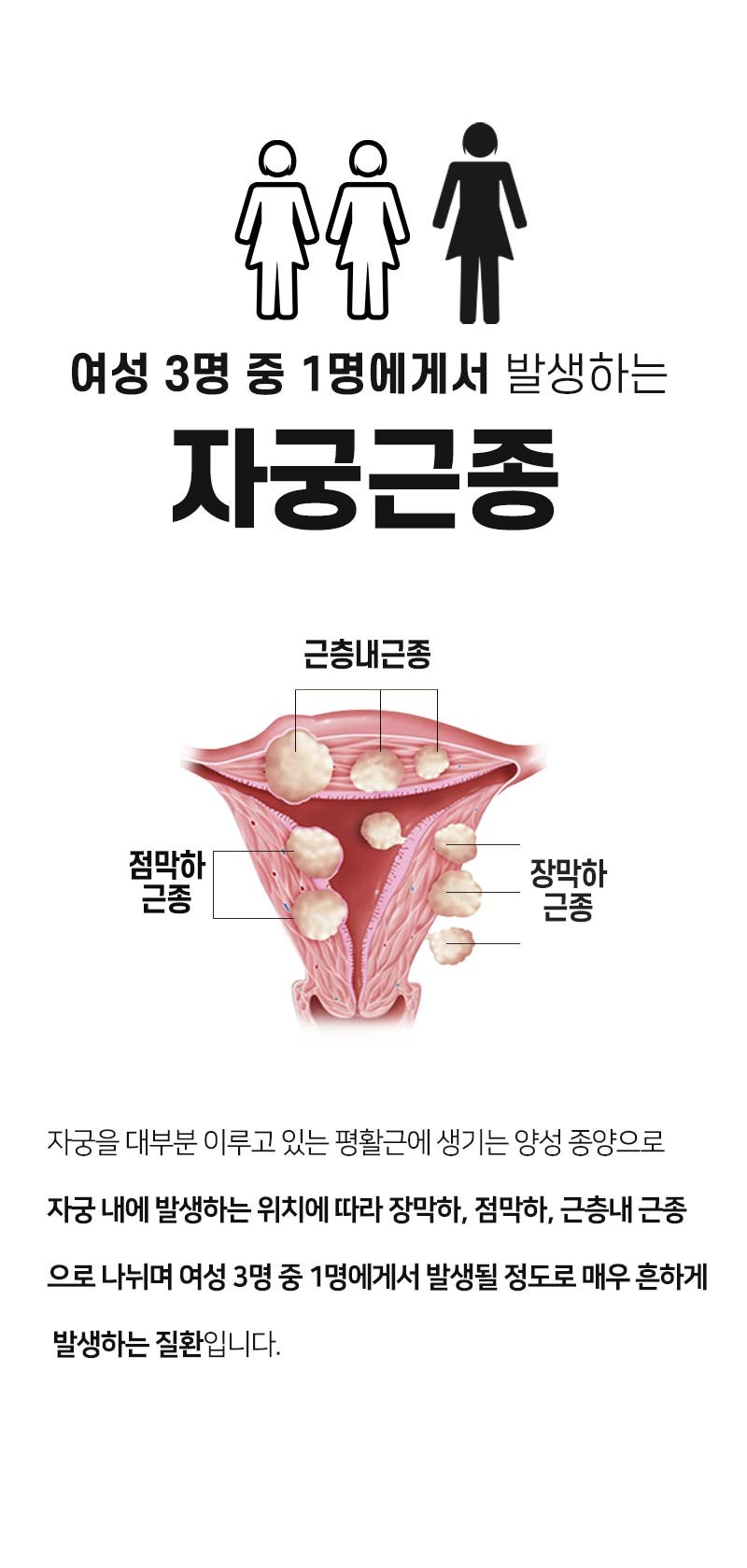 부산선근증으로 인한 불임 예방 3