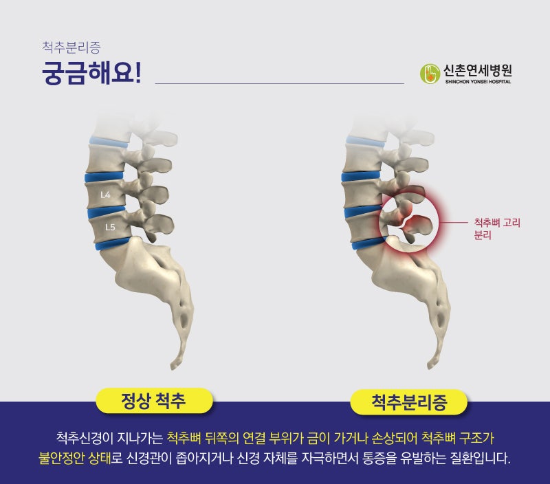 척추전방전위증 통증 치료를 위한 Kongde Cave Manipulation 2