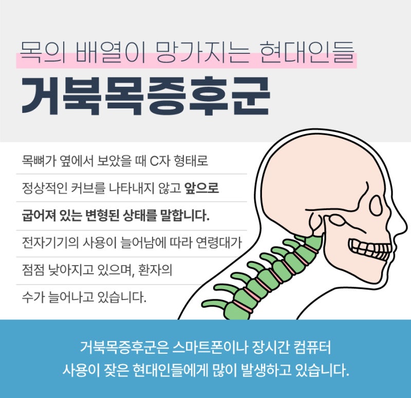 부개동 정형외과, 편두통 원인 거북목증후군의 증상 및 치료는