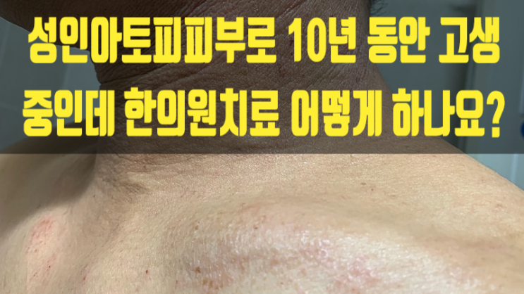  성인아토피 피부로 10년 동안 고생 중인데 한의원치료 어떻게 하나요?
