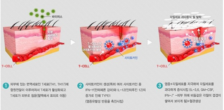  [뇽약사] 건선이란??? 발병기전, 치료방법, 국소치료제, 광선치료, 면역억제제, 생물학적제제