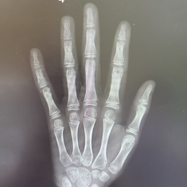 손가락 골절 증상 타박상 손톱멍 피멍