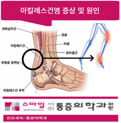  [일산발뒤꿈치통증치료] 아킬레스건염 원인 및 증상은?