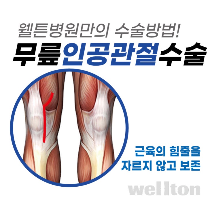 무릎 인공관절 수술 :: 웰튼병원이 대퇴사두근의 힘줄을 자르지 않는 이유