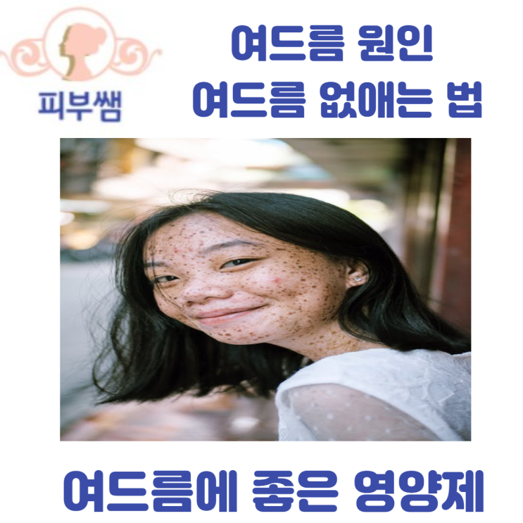  여드름원인, 여드름 없애는 법, 여드름에 좋은 영양제