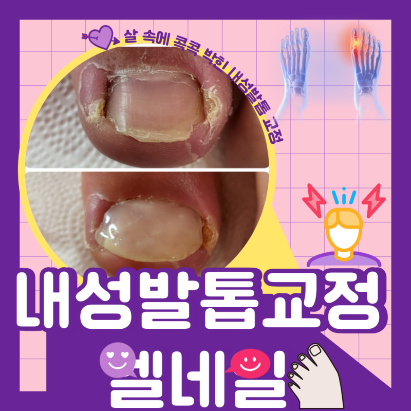[전주·익산·군산내성발톱] 고등학생~아파서 계속 자른 내성발톱~ 자를수록 더 들어가 염증....