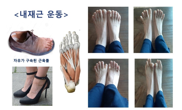  족저근막염(Plantar Fascitiitis)의 해법. 아침마사지와 스트레칭, 내재근운동, 깔창