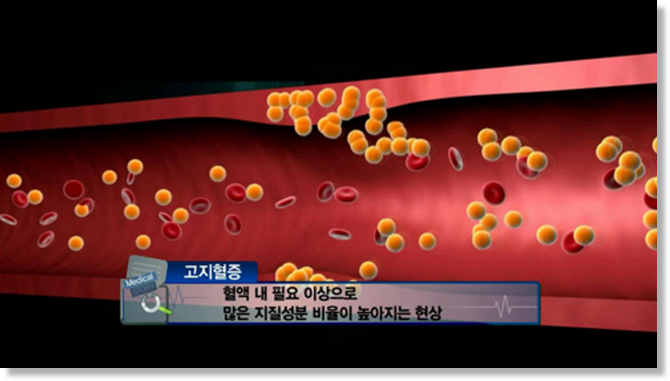  고지혈증 & 콜레스테롤과 이별하기.