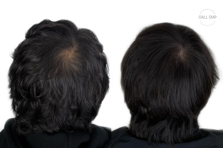  [OALL Scalp studio] 남성 탈모 정수리 smp시술