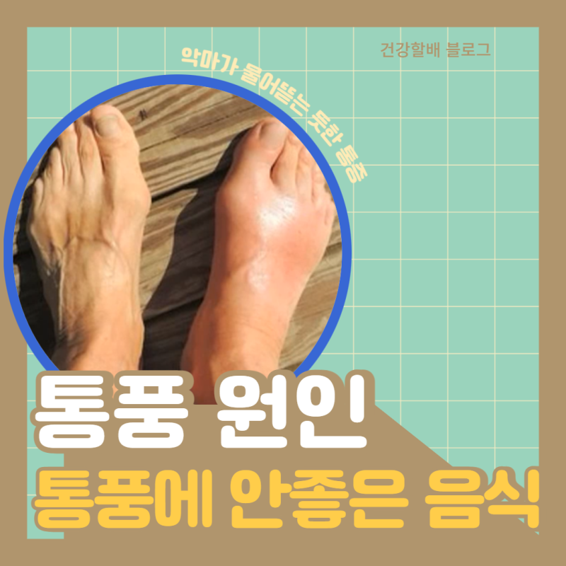 통풍의 원인 초기 증상, 요산 통풍에 좋지 않은 음식