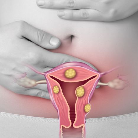 자궁근종_매년 12%씩 증가하는 여성 질환