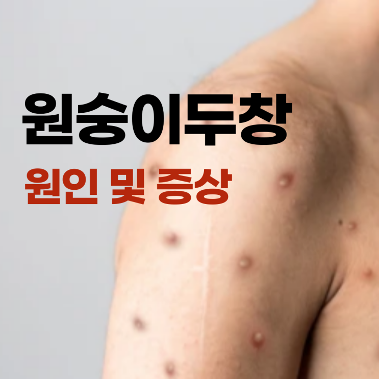  원숭이두창 감염 경로 증상 순서, 잠복기