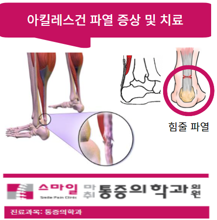  [발뒤꿈치통증원인] 아킬레스건파열 원인.증상 및 치료법