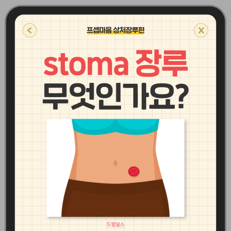 stoma 장루 정의부터 수술 전후 간호까지 stoma 장루 정의부터 수술 전후 간호까지
