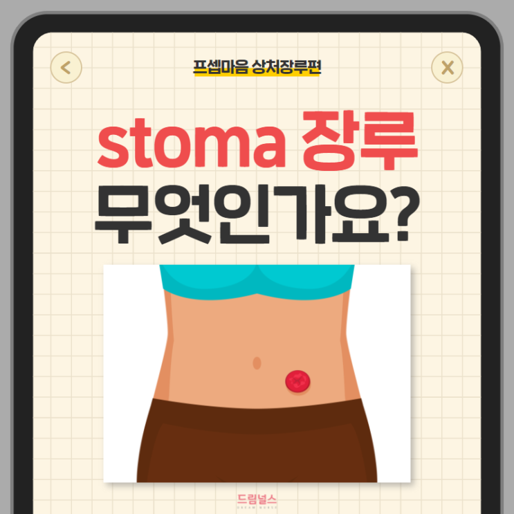 stoma 장루 정의부터 수술 전후 간호까지