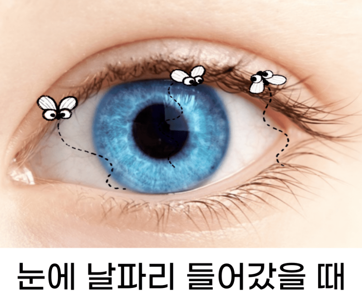  눈에 날파리 들어갔을 때 해결하는 방법이란?