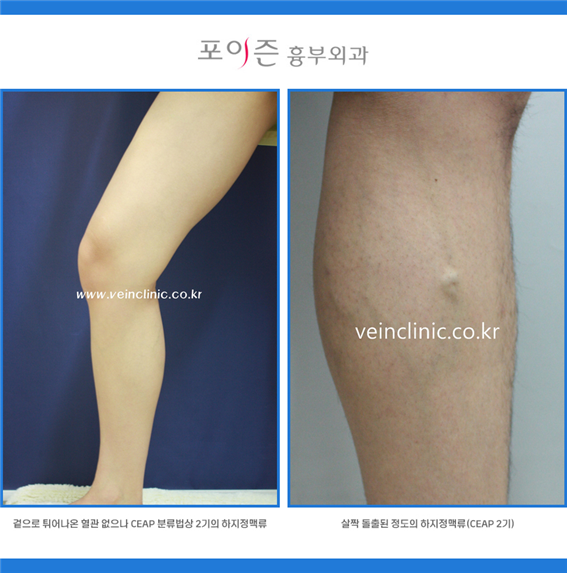 다리부종병원 원인 하지정맥류 증상일까? 4
