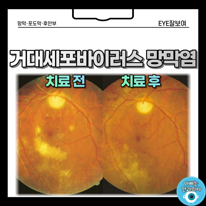  거대세포바이러스 망막염 치료