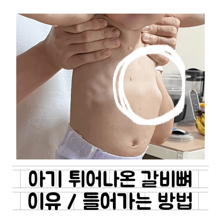  [정보] 10개월 아기 튀어나온 갈비뼈 : 돌출 이유 / 들어가는 방법