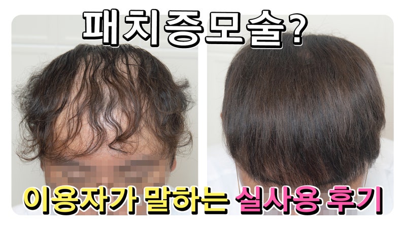남자 헤어증모술 가격 행사 놓치면 안될것 같아요 11