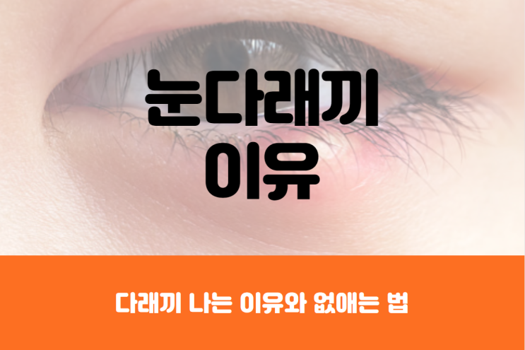  다래끼 나는 이유, 빨리 낫는 법