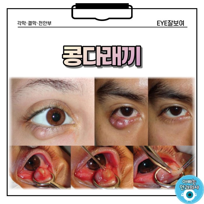  콩다래끼 - 원인, 증상, 치료