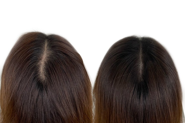  [OALL Scalp Studio] 여성 가르마 컴플렉스 보완 smp시술
