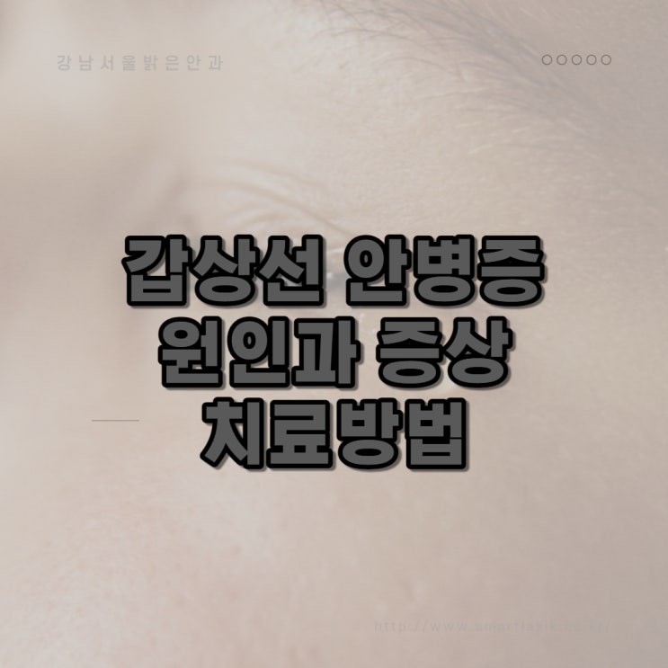  갑상선기능이상 갑상선안병증의 원인과 증상 치료방법