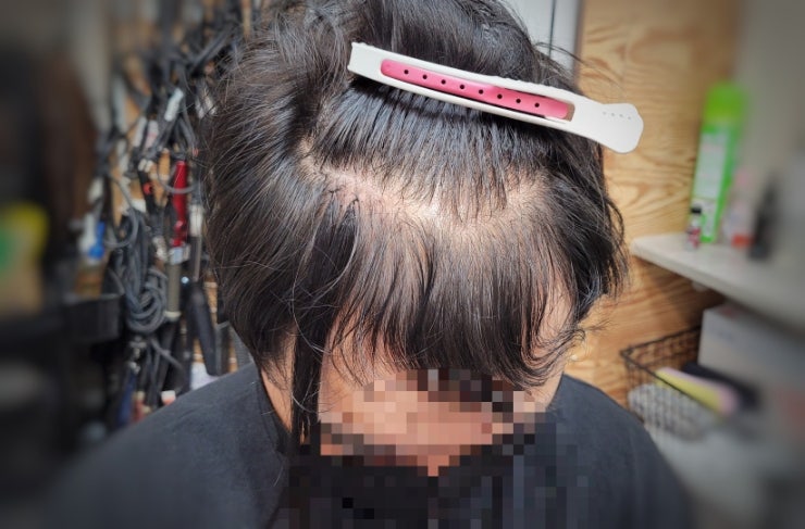 진주 사천 남자 앞머리 탈모.앞머리 양 때문에 가발&연장은 뭐가 좋을까?