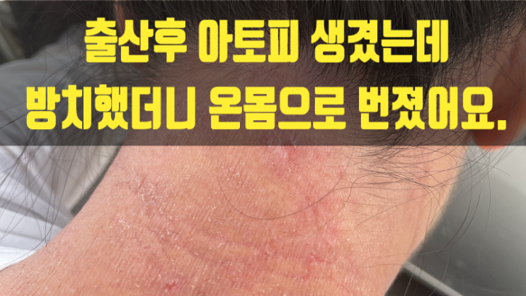  출산후 아토피 생겼는데 방치했더니 온몸으로 번졌어요.