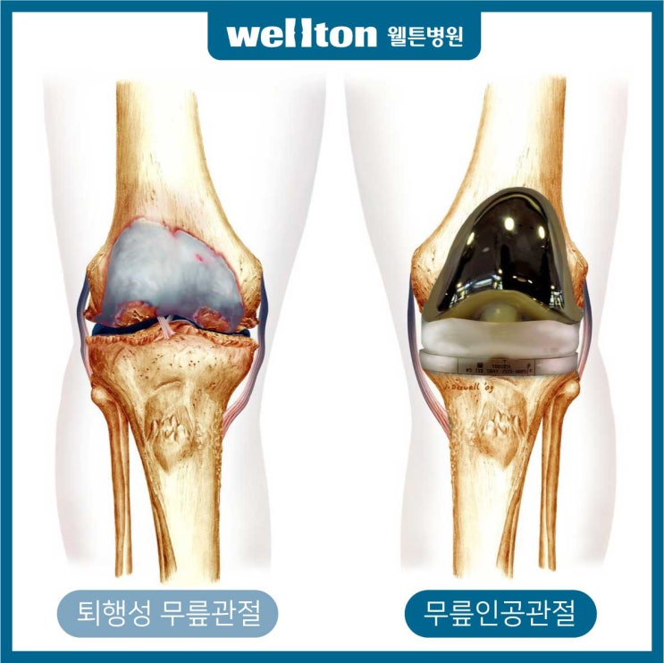  무릎 인공관절수술 시기는 언제일까?