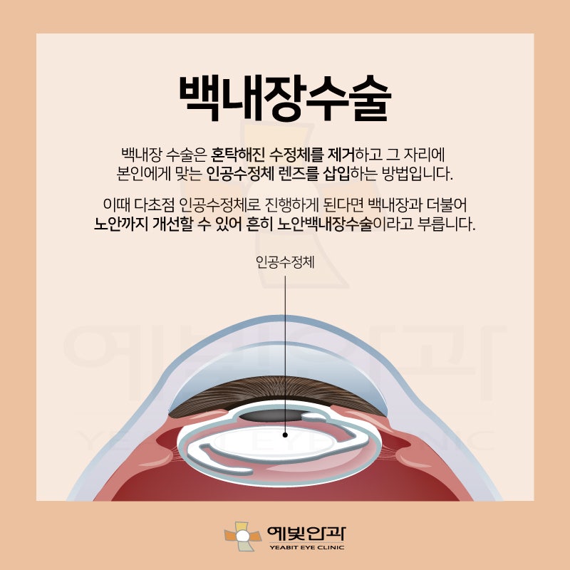 백내장 보험