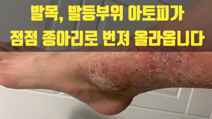  발목, 발등부위 아토피가 점점 종아리로 번져 올라옵니다