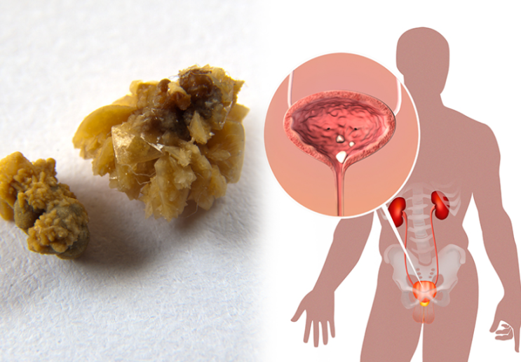  [스마일 웰빙.건강 이야기 5탄] 여름철.장마철 건강관리 필수! 여름건강하게보내는팁(칼륨섭취, 냉각기청소, 냉방병 예방, 자외선 차단 등)