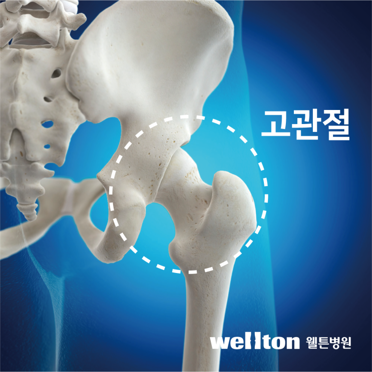  고관절 인공관절수술 특징 알아보기!