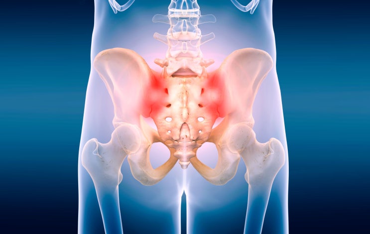  [평택안성재활,체형교정]천장관절 증후군(Sacroiliac Joint Syndrome)임산부-환도 선다