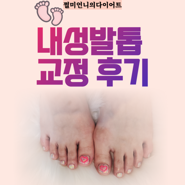  내성발톱 원인과 교정 방법 및 비용 공개 (신림 하이 피피 헤어앤 네일)