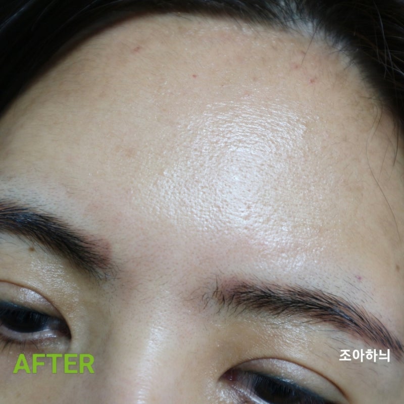 라보타치 미간 주름 패치 & 턱 리프팅 밴드로 얼굴리프팅 주름관리 : 네이버 블로그