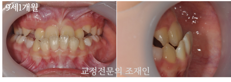  어린이 반대교합의 치료, 페이스마스크(face mask)