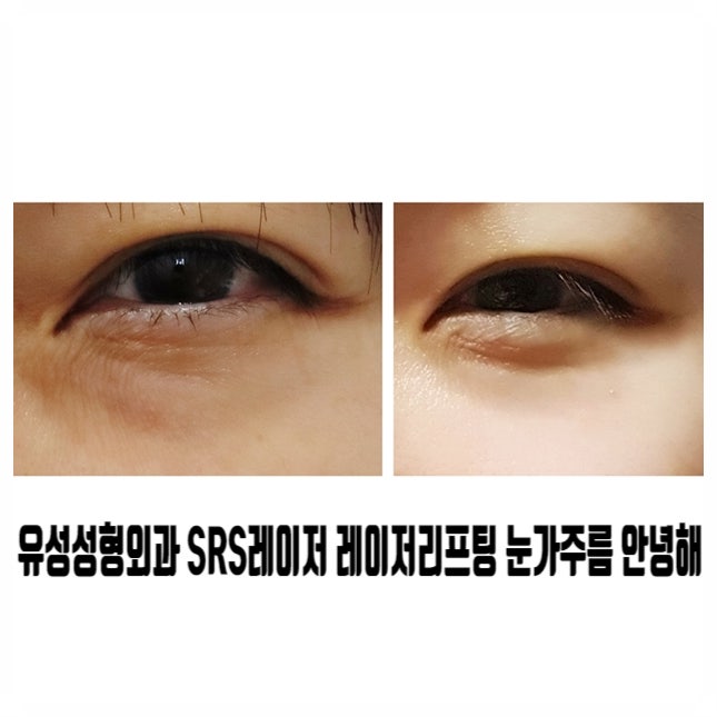  유성성형외과 SRS레이저 레이저리프팅 눈가주름 안녕해