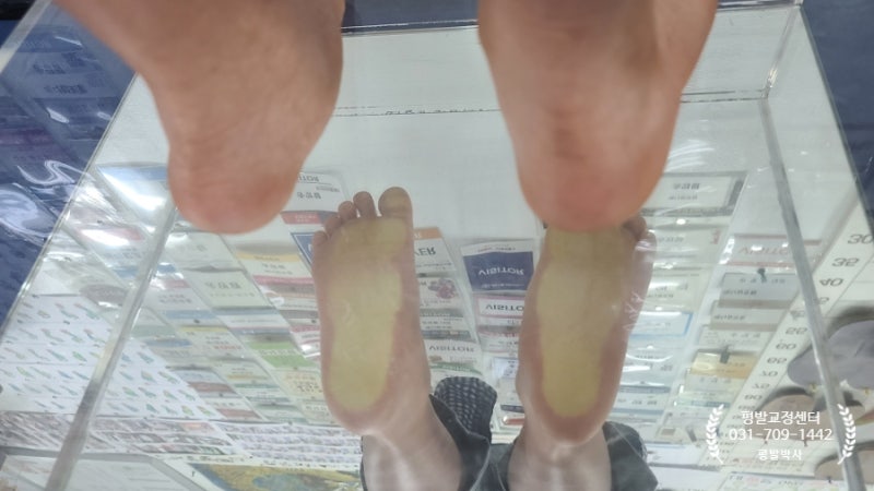 8살 남자아이, 평발 교정 병원에서 2년 전에 하고 평발 교정 센터에서 다시 시작합니다. 8살 남자아이, 평발 교정 병원에서 2년 전에 하고 평발 교정 센터에서 다시 시작합니다.