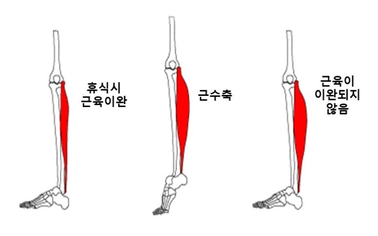  운동할 때, 잘 때 다리 종아리 쥐 나는 이유, 쥐나는 이유 muscle cramp, Charley Horse
