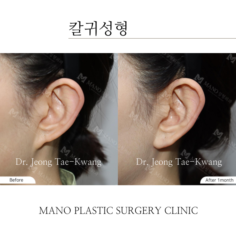 귀성형 수술 잘하는 곳 돌출귀 및 칼귀성형 사례 : 네이버 블로그 귀성형 수술 잘하는 곳 돌출귀 및 칼귀성형 사례 : 네이버 블로그