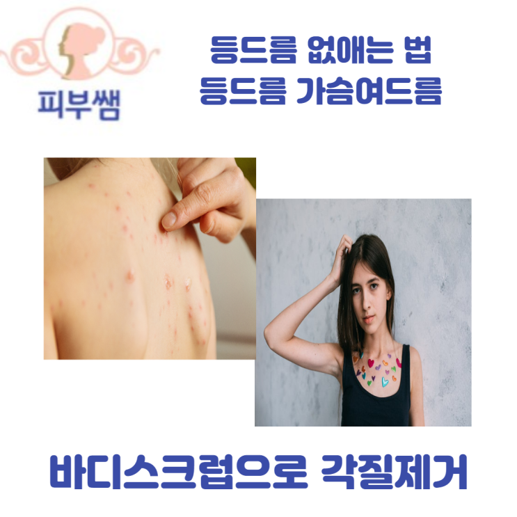  등드름 없애는 법 등드름 가슴여드름 바디스크럽 으로 각질제거