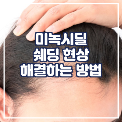  미녹시딜 쉐딩 현상, 해결하는 방법