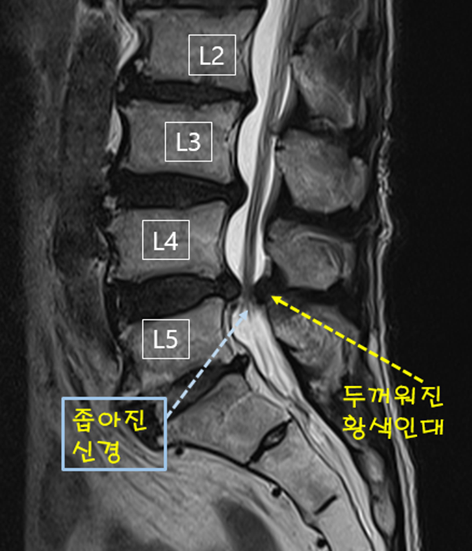  간헐적 파행으로 고통받으시던 환자분의 허리협착증 치료 증례 (내시경 척추 감압술) 2